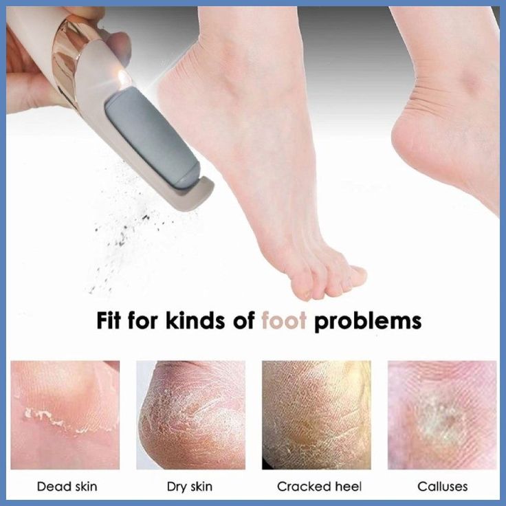 Cordless Electric Foot Callus Remover | Salon-Smooth Heels in Minutes (Rechargeable, Pain-Free)