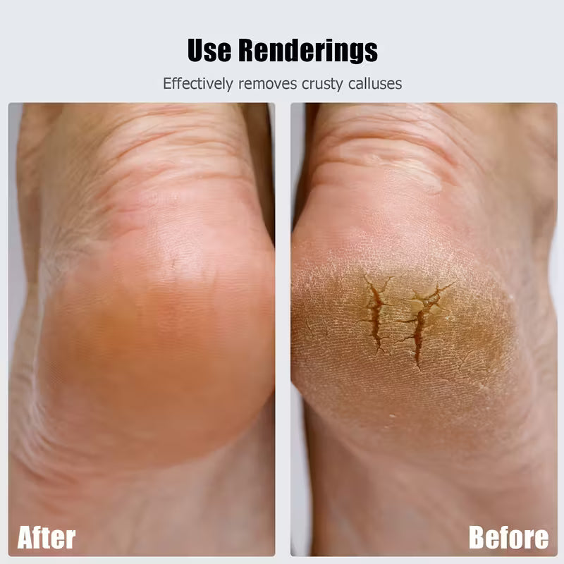 Cordless Electric Foot Callus Remover | Salon-Smooth Heels in Minutes (Rechargeable, Pain-Free)